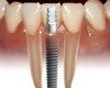 Dental Implants – What Are They?