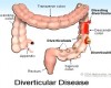 How to Tell If You Have Diverticulitis – Signs and Symptoms