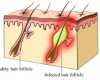 Ingrown Hair Removal Treatment and Remedies