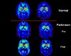 There Is More to Parkinson’s Disease Than a Tremor