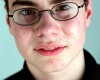 Teenager Troubles: Dealing With Acne During Adolescence