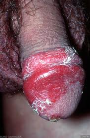 mens health bacterial infections