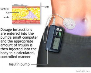 an insulin pump men's health