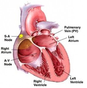 arrhythmia