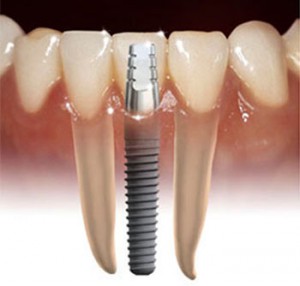 men's health dental-implant