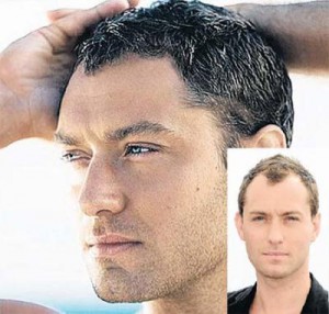 hair replacement therapy men's health