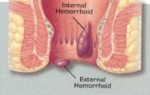 hemorrhoids men's health