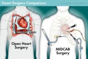 invasive heart surgery men's health