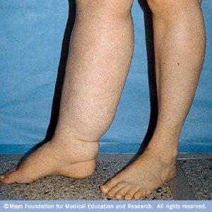 lymphedema men's health