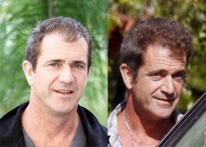 mel gibson hair transplant men's health