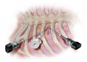 minimally invasive heart surgery men's health