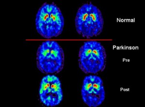 parkinson's disease men's health