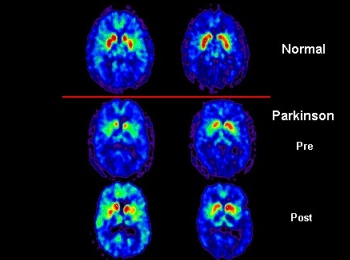 parkinson's disease men's health