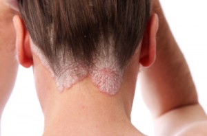 psoriasis men's health